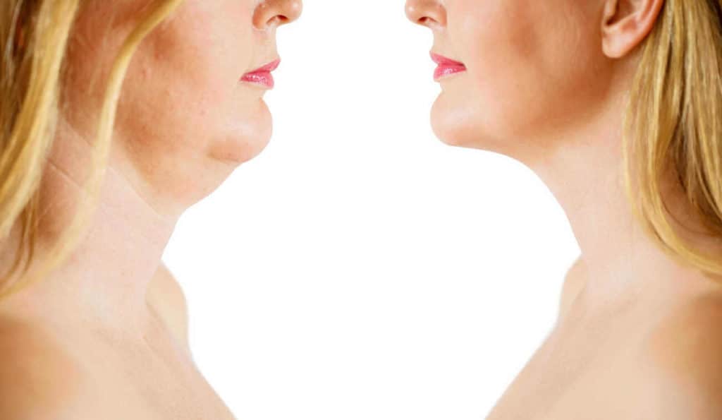 Double Chin treatment Bexleyheath before and after results