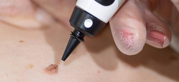 After Skin Tag Removal Bexleyheath