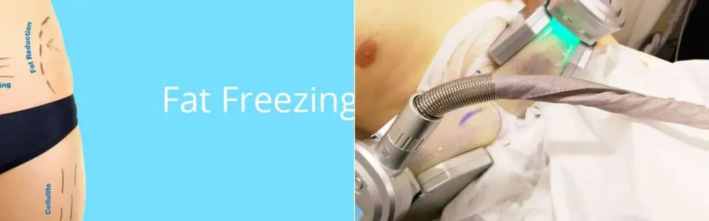 multi areas of a persons body having coolsculpting Bexleyheath treatment