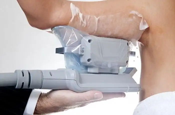Picture of fat freezing Bexleyheath on the upper arms.