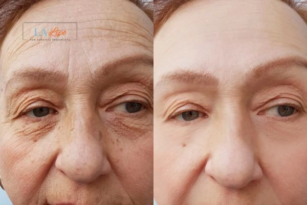 The powerful benefits of Morpheus8 Treatment Bexleyheath - Call Our team today!